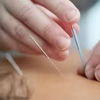 Acupuncture needles